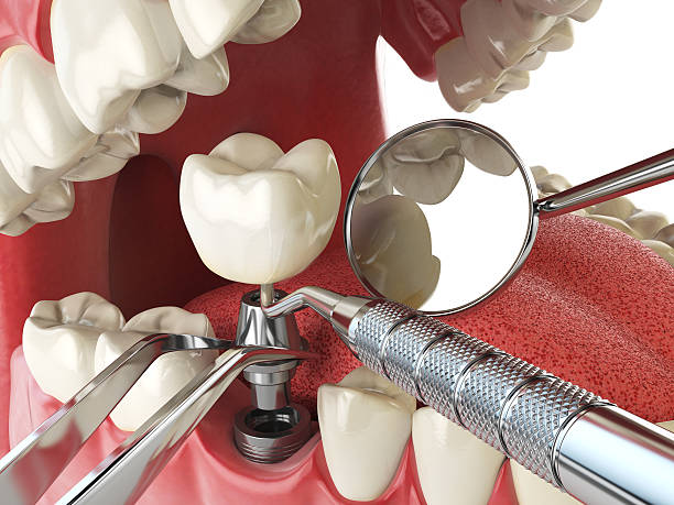 Best Emergency Dental Care for Abscessed Tooth in Mapleton, ND